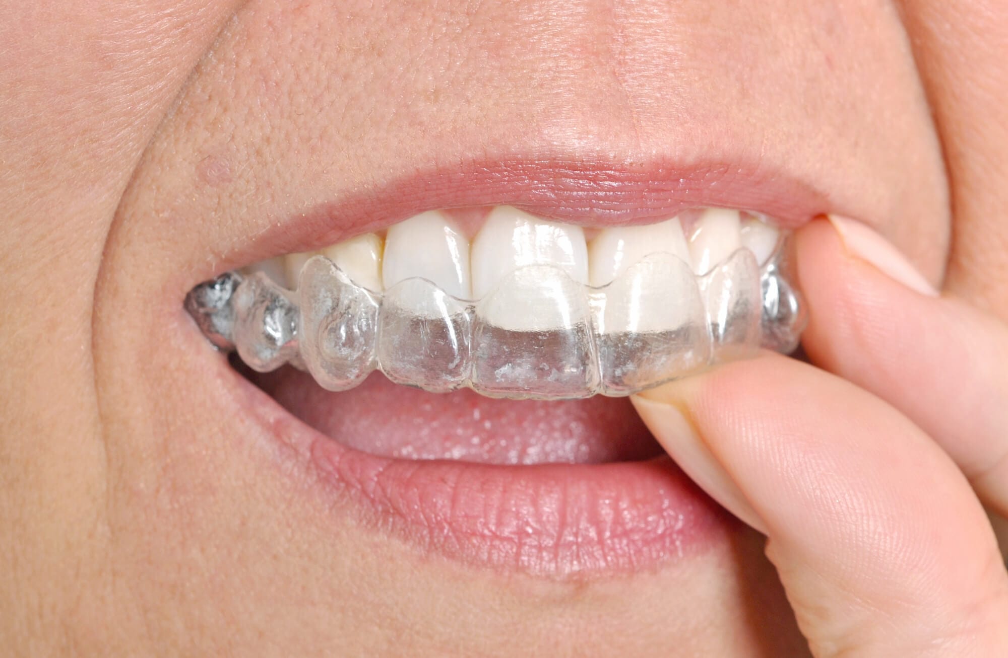 What is Invisalign clear aligner?