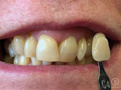 Before - Battersea Smiles