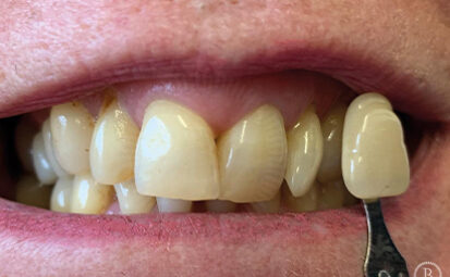 Before - Battersea Smiles