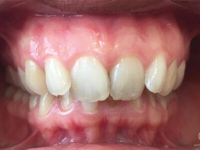 Before - Battersea Smiles