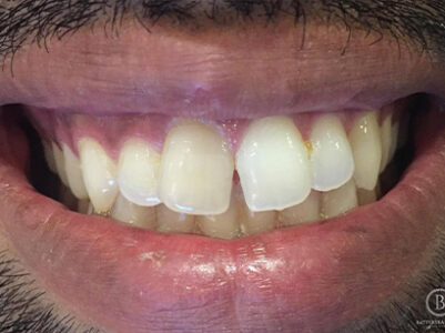 Before - Battersea Smiles