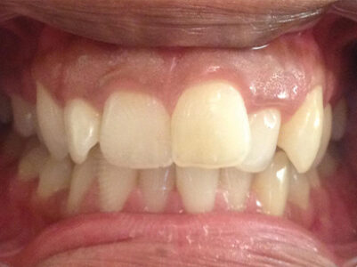 Before - Battersea Smiles