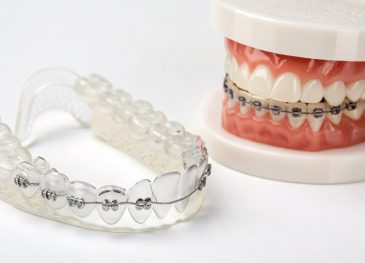 Editorial hero image illustrating Invisalign vs Fixed Braces for Adults: Which Orthodontic Treatment Suits You? for a dentist brand.